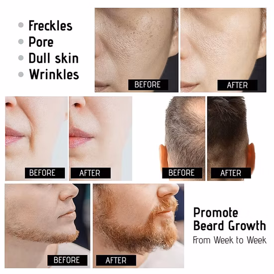 2019 Top Selling Micro Needle 540 Derma Roller